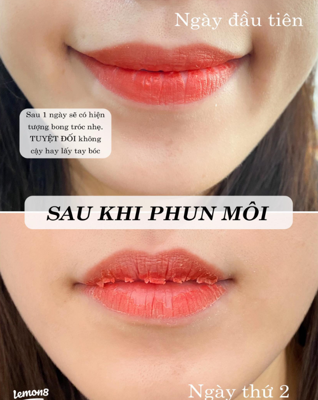 Khách hàng trong giai đoạn hồi phục sau phun môi