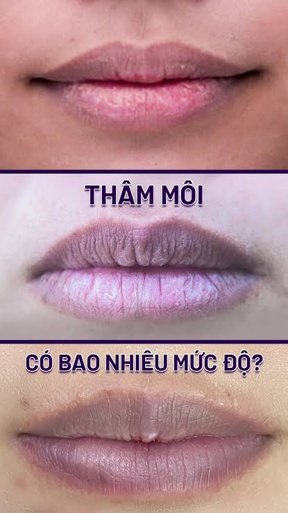Môi bị đen có phun được không? Cách xử lý để lên màu đẹp