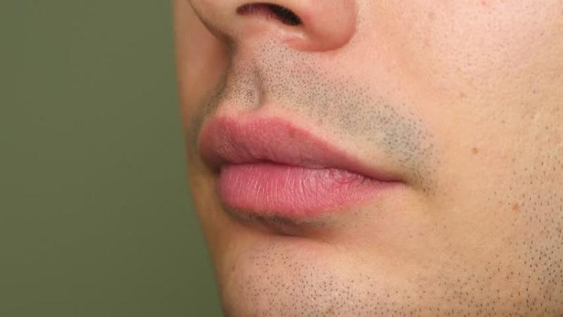 Nam giới tư vấn khử thâm môi để cải thiện sắc tố môi