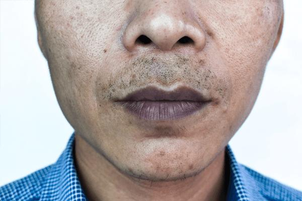 Những nguyên nhân phổ biến khiến môi nam giới bị thâm