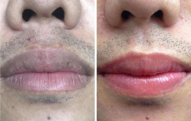 Kết quả khử thâm môi tự nhiên dành cho nam giới