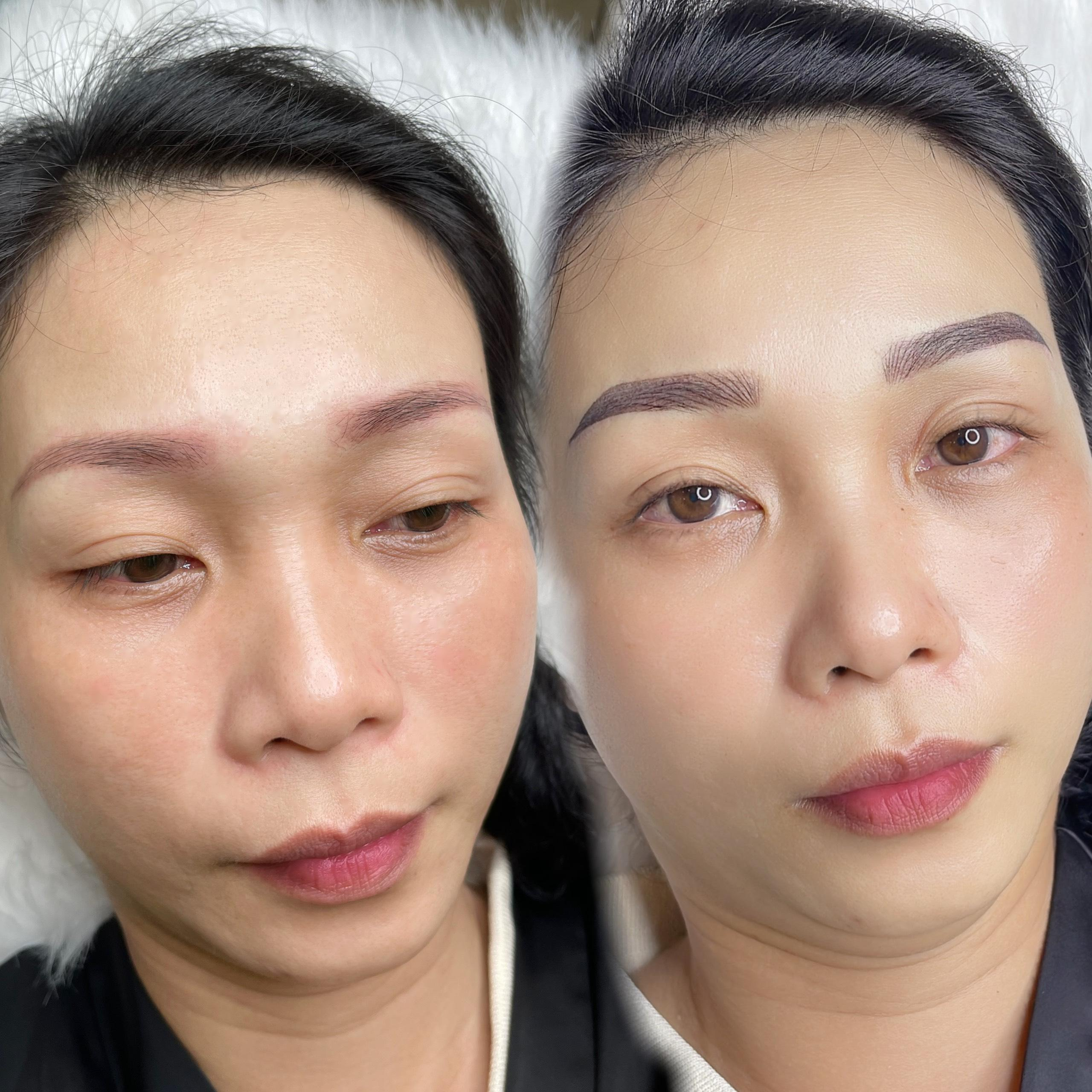 Mày bị xanh sau nhiều năm có xử lý được không