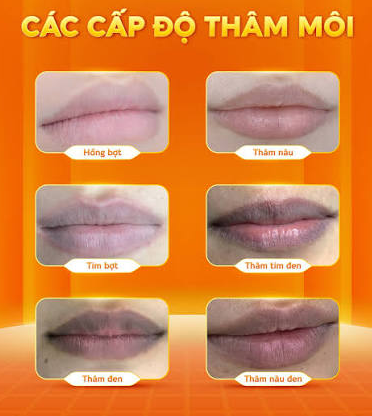 Các cấp độ môi bị đen và thâm