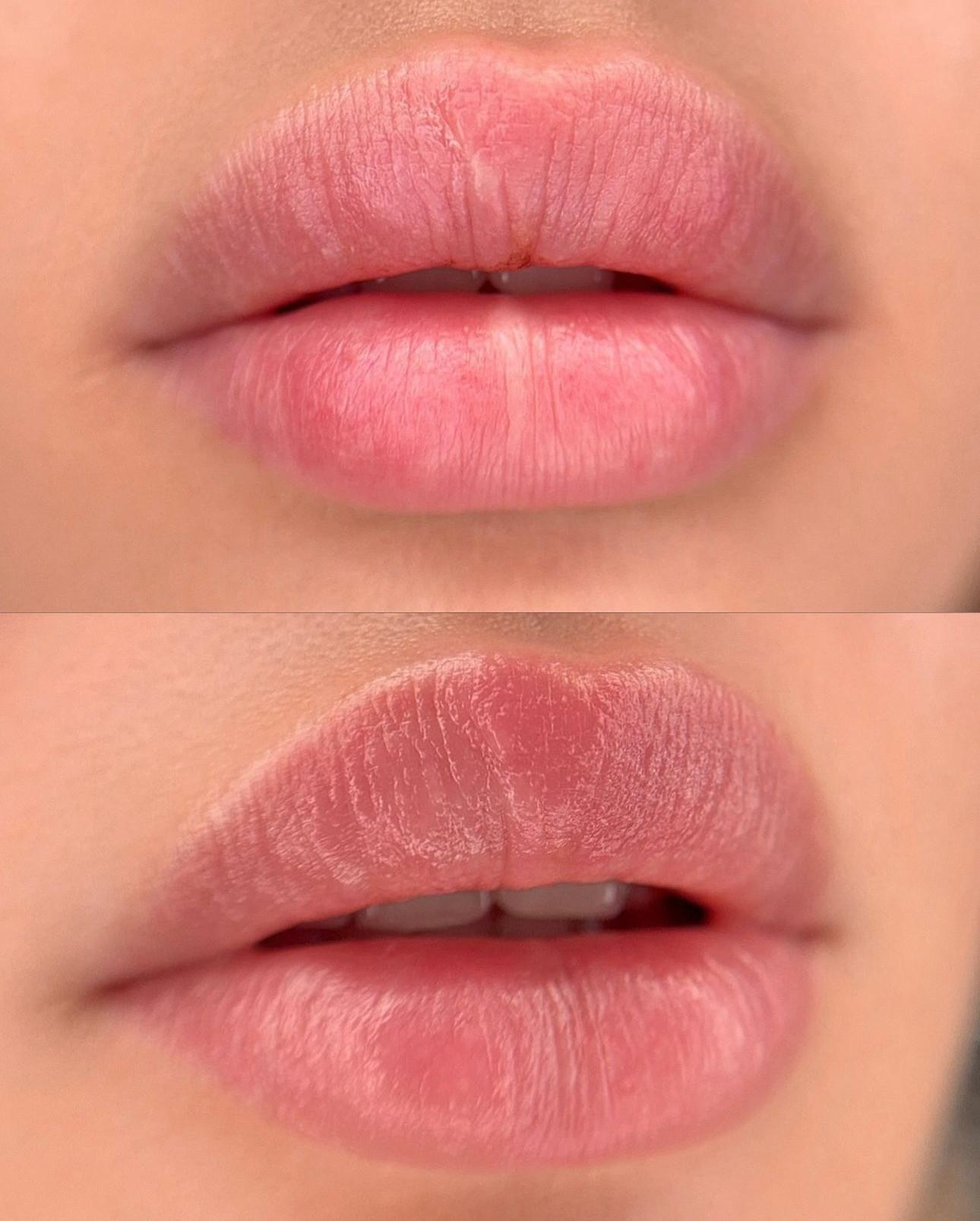 Kết quả đôi môi sau khi hồi phục ổn định
